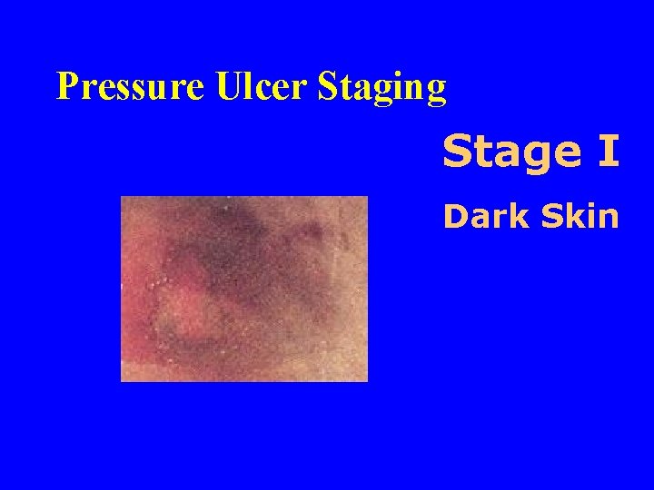 Pressure Ulcer Staging Stage I Dark Skin 