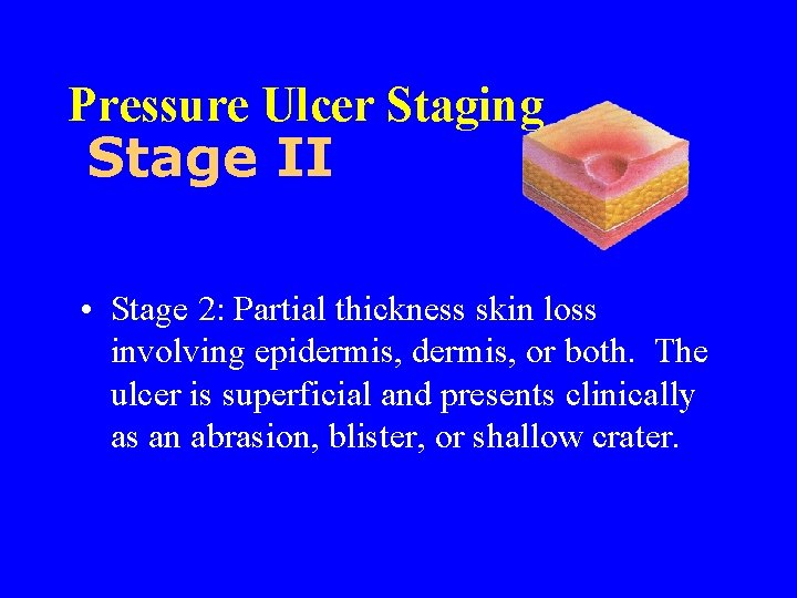 Pressure Ulcer Staging Stage II • Stage 2: Partial thickness skin loss involving epidermis,