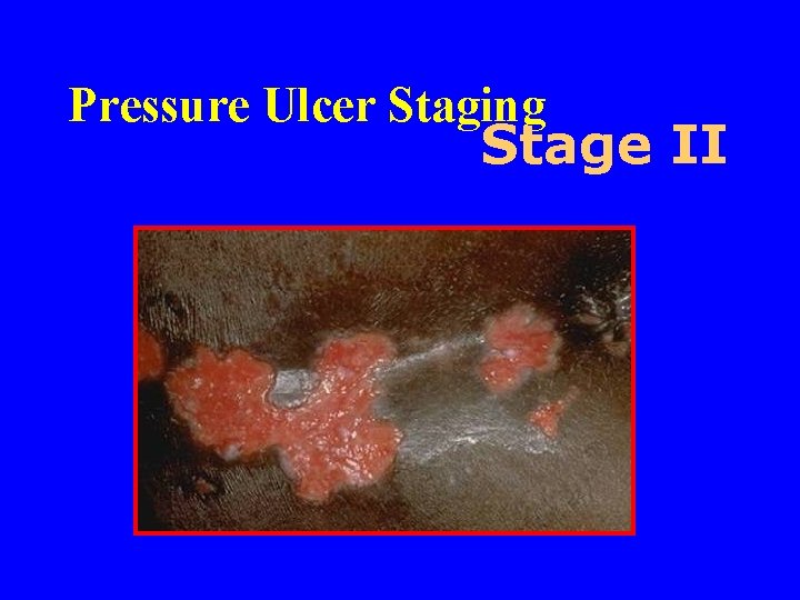 Pressure Ulcer Staging Stage II 