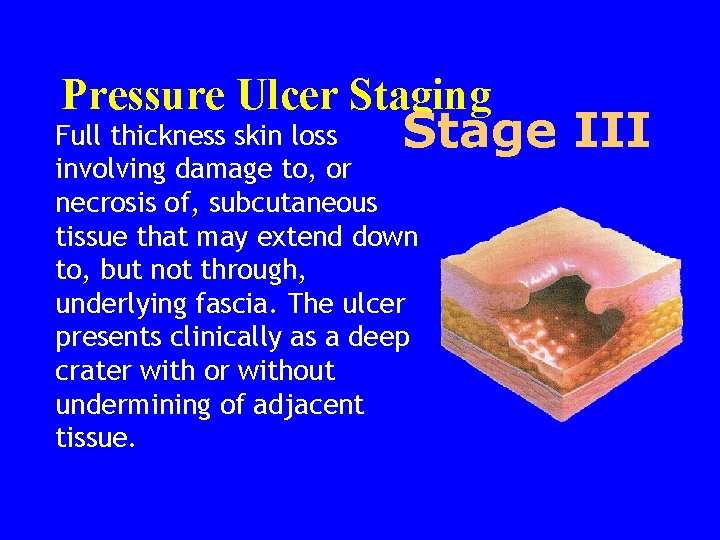 Pressure Ulcer Staging Stage III Full thickness skin loss involving damage to, or necrosis