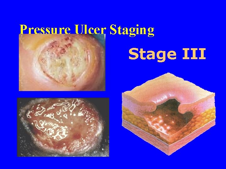 Pressure Ulcer Staging Stage III 