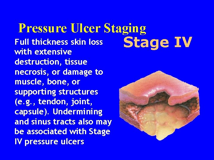 Pressure Ulcer Staging Full thickness skin loss with extensive destruction, tissue necrosis, or damage