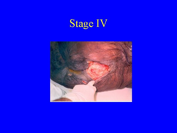 Stage IV 