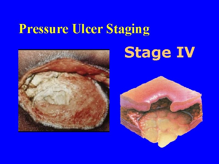 Pressure Ulcer Staging Stage IV 