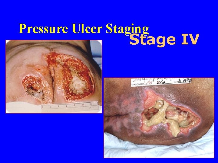 Pressure Ulcer Staging Stage IV 