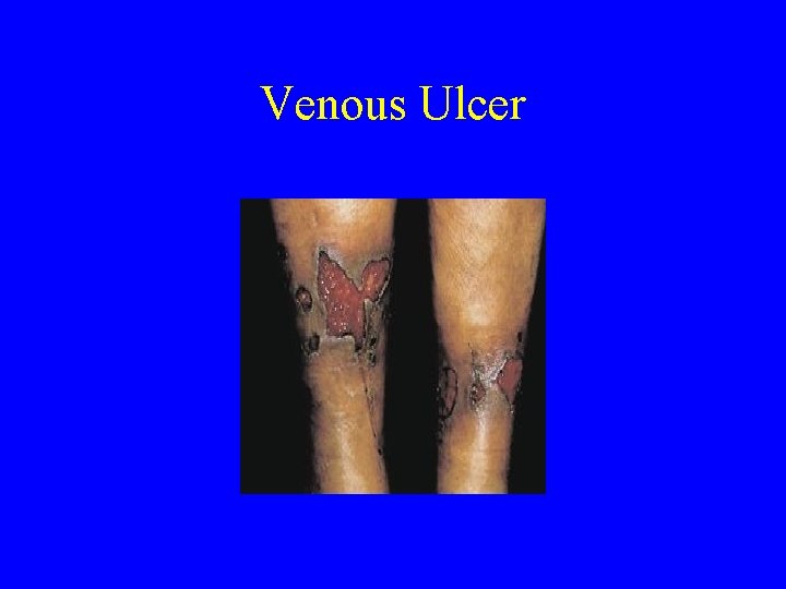 Venous Ulcer 