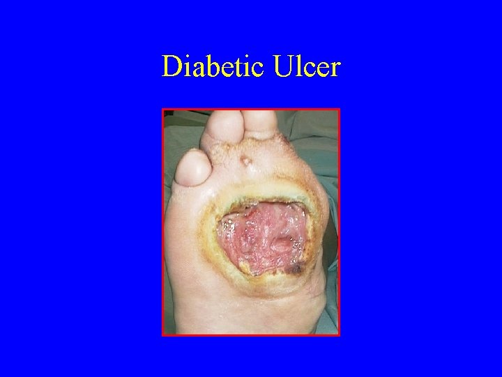 Diabetic Ulcer 