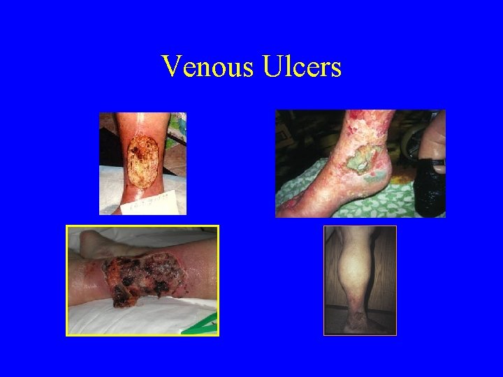 Venous Ulcers 