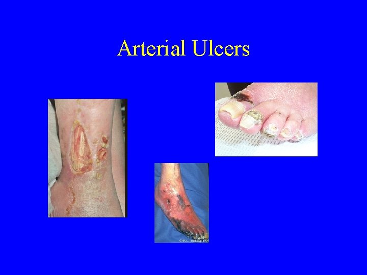 Arterial Ulcers 