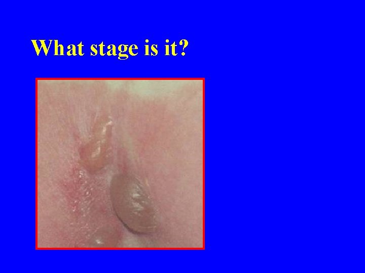 What stage is it? 