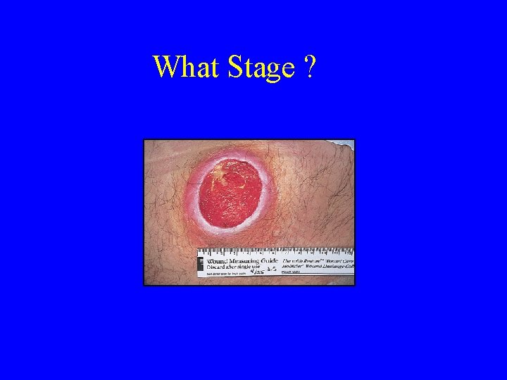 What Stage ? 