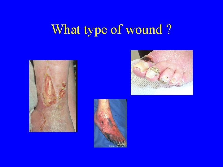 What type of wound ? 