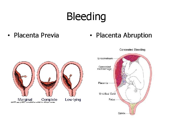 Bleeding • Placenta Previa • Placenta Abruption 