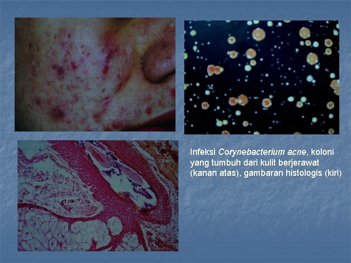 Infeksi Corynebacterium acne, koloni yang tumbuh dari kulit berjerawat (kanan atas), gambaran histologis (kiri)