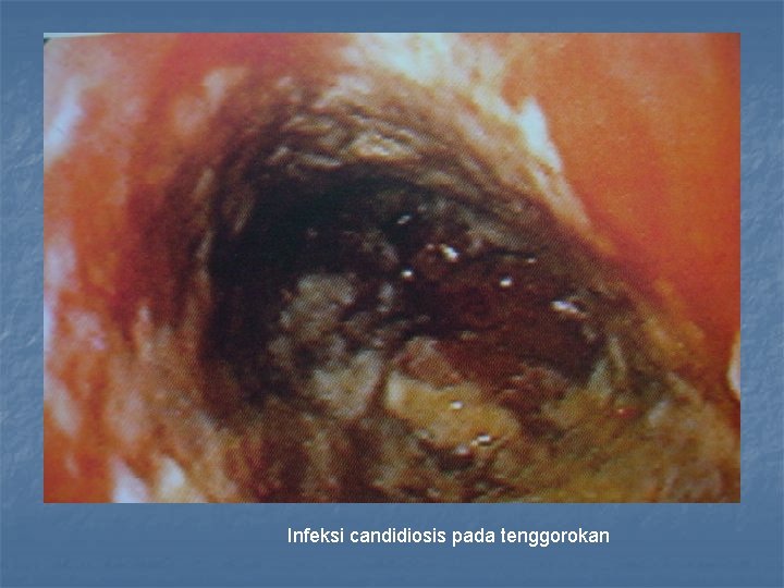 Infeksi candidiosis pada tenggorokan 