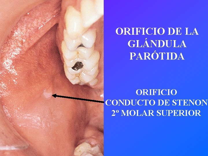 ORIFICIO DE LA GLÁNDULA PARÓTIDA ORIFICIO CONDUCTO DE STENON 2º MOLAR SUPERIOR 