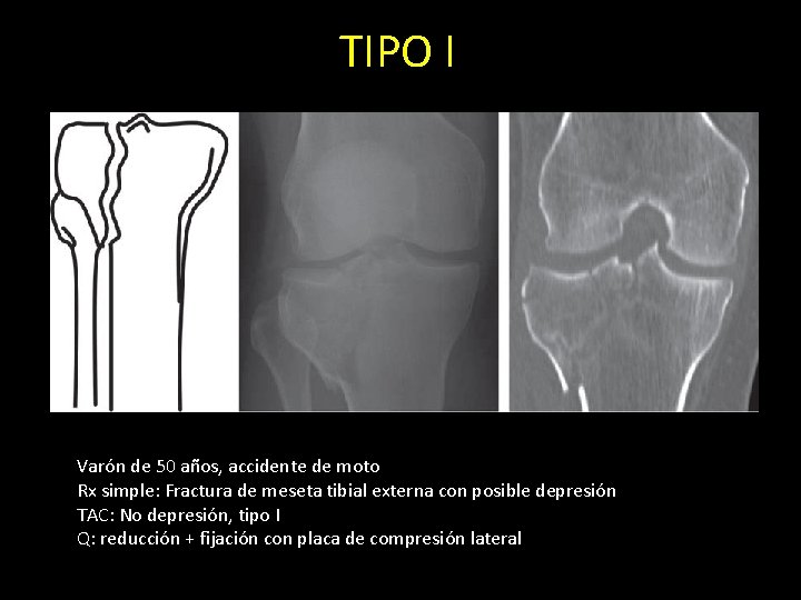 TIPO I Varón de 50 años, accidente de moto Rx simple: Fractura de meseta