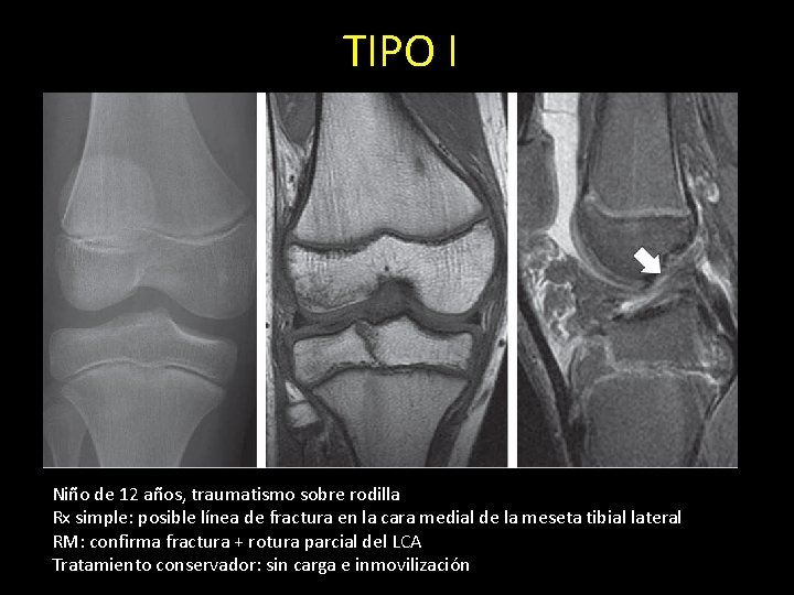 TIPO I Niño de 12 años, traumatismo sobre rodilla Rx simple: posible línea de