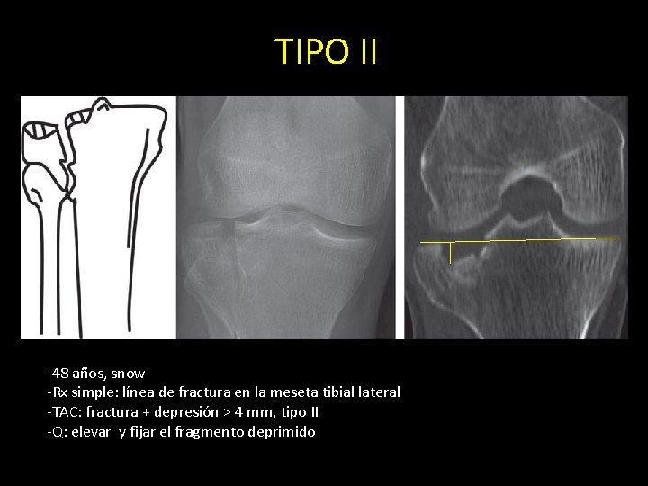 TIPO II -48 años, snow -Rx simple: línea de fractura en la meseta tibial