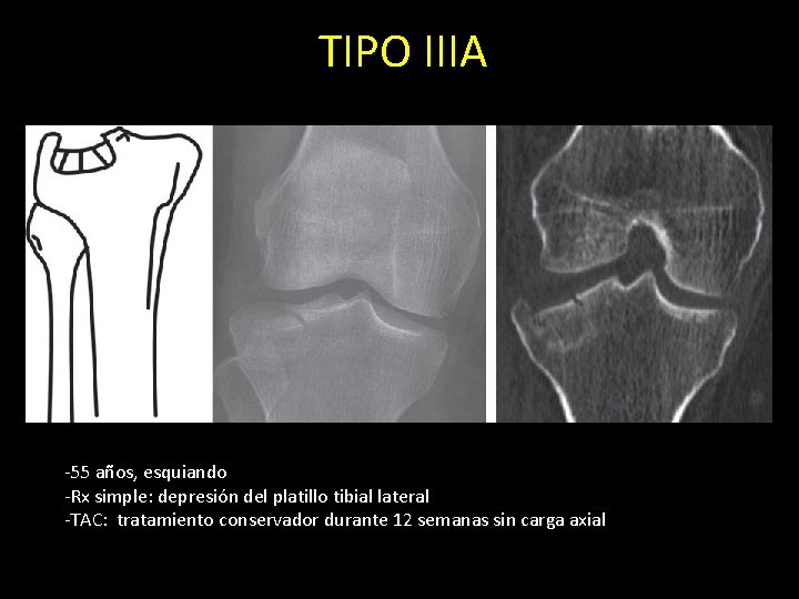 TIPO IIIA -55 años, esquiando -Rx simple: depresión del platillo tibial lateral -TAC: tratamiento