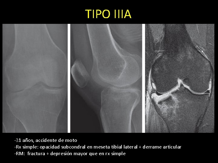 TIPO IIIA -31 años, accidente de moto -Rx simple: opacidad subcondral en meseta tibial