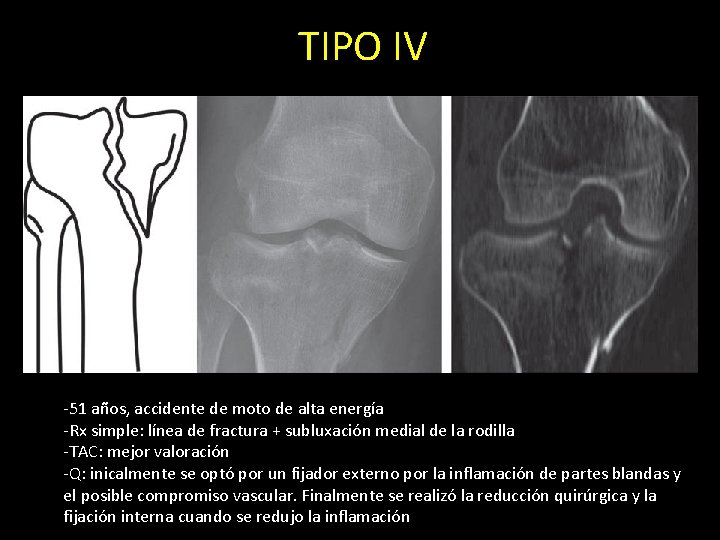 TIPO IV -51 años, accidente de moto de alta energía -Rx simple: línea de