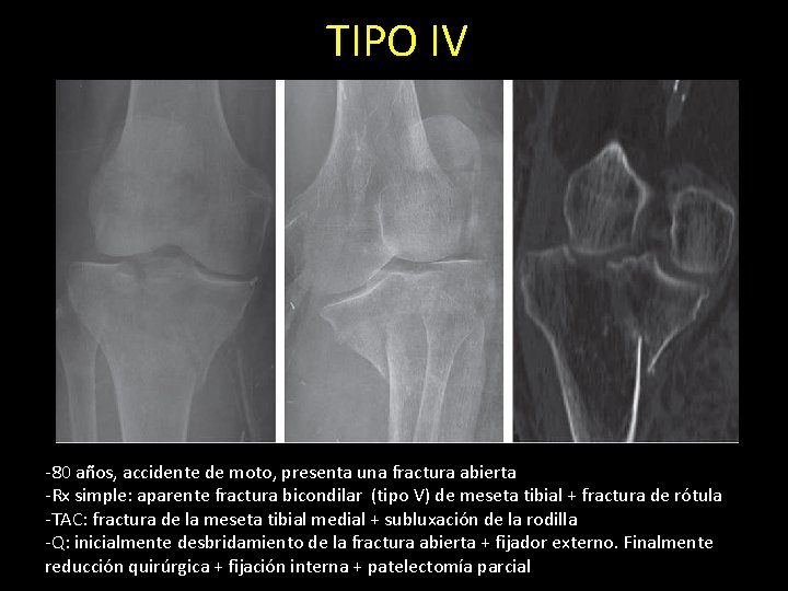 TIPO IV -80 años, accidente de moto, presenta una fractura abierta -Rx simple: aparente