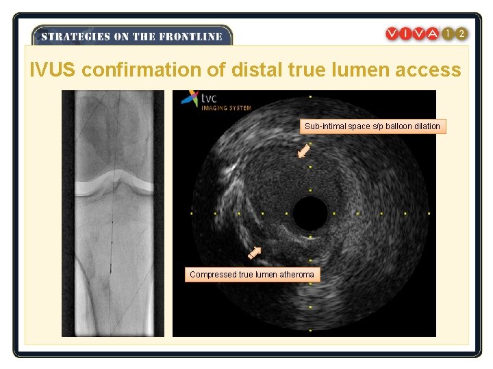 IVUS confirmation of distal true lumen access Sub-intimal space s/p balloon dilation Compressed true