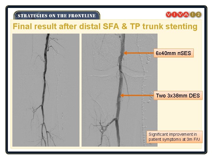 Final result after distal SFA & TP trunk stenting 6 x 40 mm n.