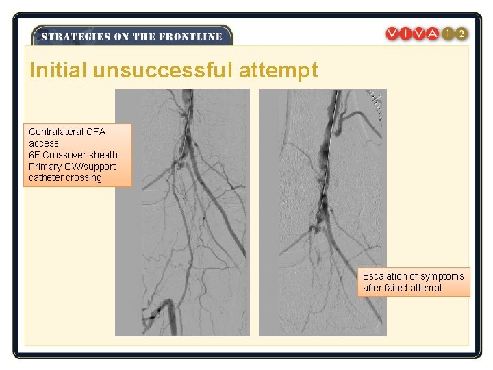 Initial unsuccessful attempt Contralateral CFA access 6 F Crossover sheath Primary GW/support catheter crossing