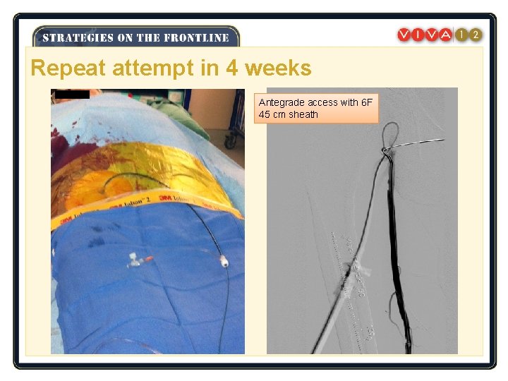 Repeat attempt in 4 weeks Antegrade access with 6 F 45 cm sheath 