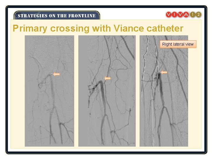 Primary crossing with Viance catheter Right lateral view 