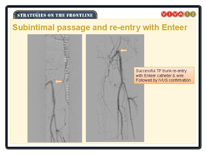 Subintimal passage and re-entry with Enteer Successful TP trunk re-entry with Enteer catheter &