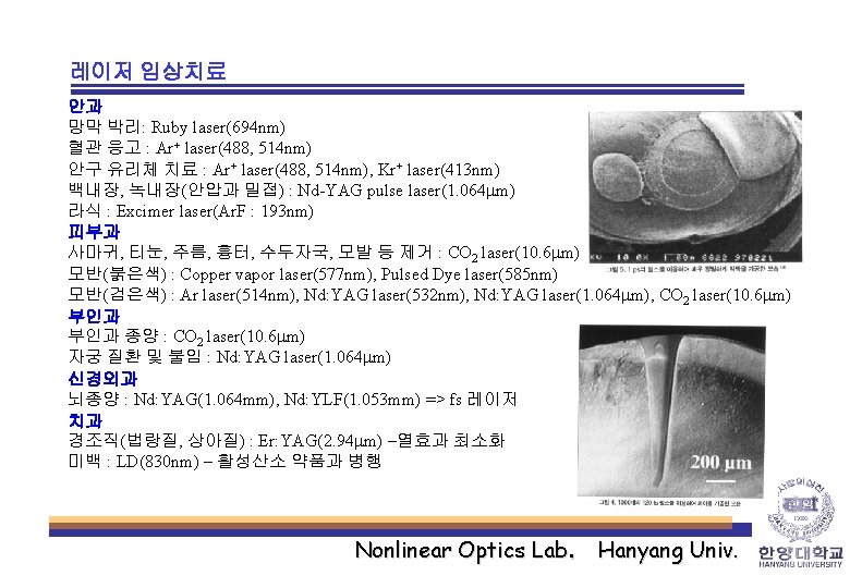 레이저 임상치료 안과 망막 박리: Ruby laser(694 nm) 혈관 응고 : Ar+ laser(488, 514