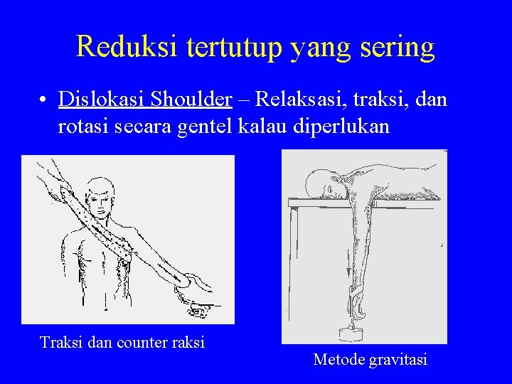 Reduksi tertutup yang sering • Dislokasi Shoulder – Relaksasi, traksi, dan rotasi secara gentel