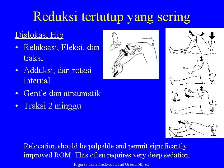 Reduksi tertutup yang sering Dislokasi Hip • Relaksasi, Fleksi, dan traksi • Adduksi, dan