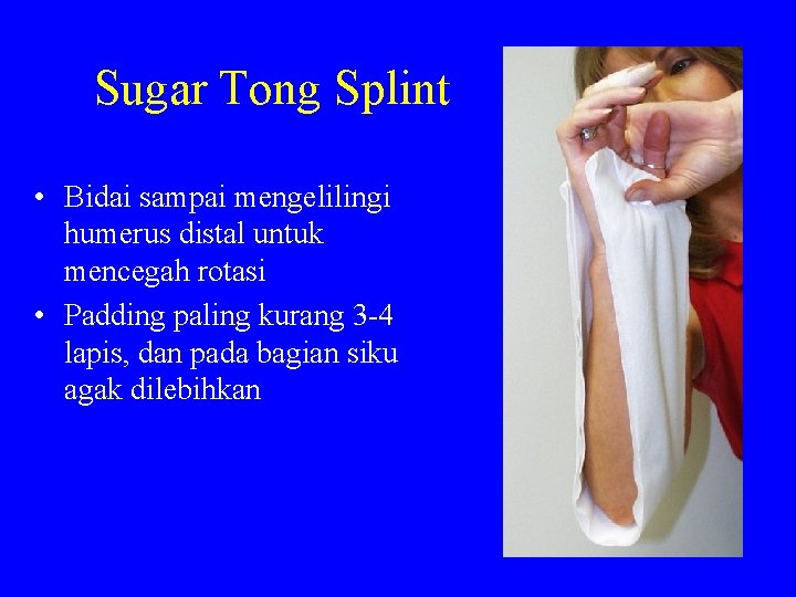 Sugar Tong Splint • Bidai sampai mengelilingi humerus distal untuk mencegah rotasi • Padding