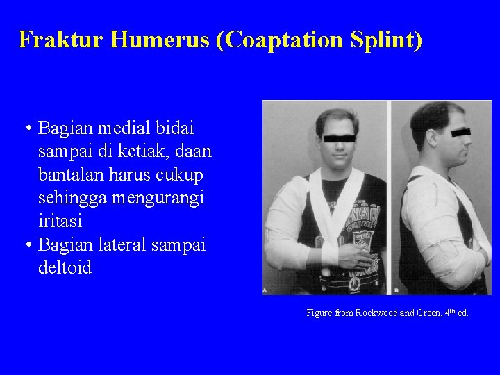 Fraktur Humerus (Coaptation Splint) • Bagian medial bidai sampai di ketiak, daan bantalan harus
