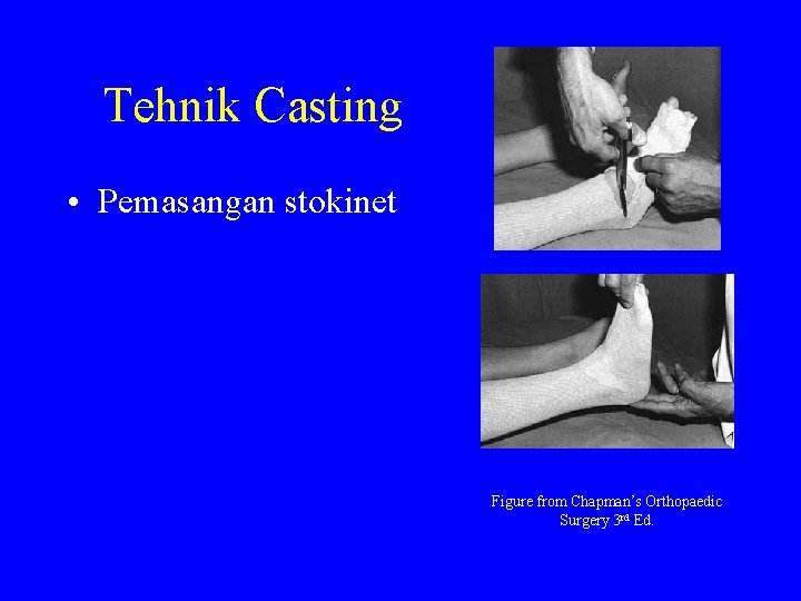 Tehnik Casting • Pemasangan stokinet Figure from Chapman’s Orthopaedic Surgery 3 rd Ed. 