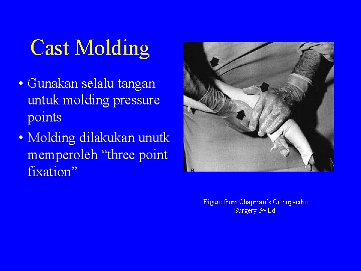 Cast Molding • Gunakan selalu tangan untuk molding pressure points • Molding dilakukan unutk
