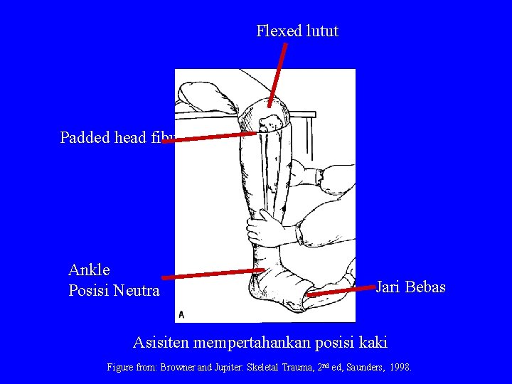 Flexed lutut Padded head fibular Ankle Posisi Neutra Jari Bebas Asisiten mempertahankan posisi kaki