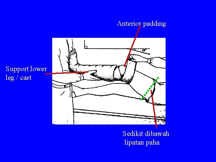 Anterior padding Support lower leg / cast Sedikit dibawah lipatan paha 