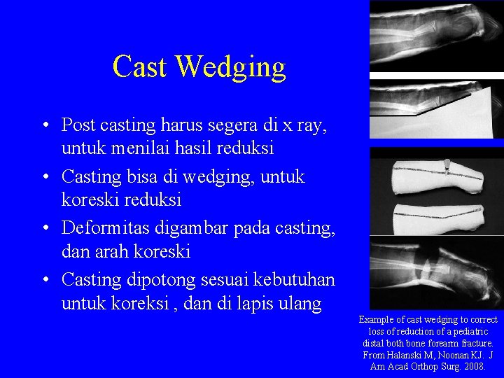 Cast Wedging • Post casting harus segera di x ray, untuk menilai hasil reduksi