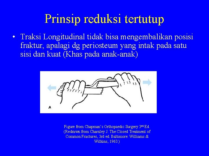 Prinsip reduksi tertutup • Traksi Longitudinal tidak bisa mengembalikan posisi fraktur, apalagi dg periosteum