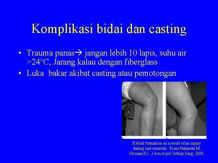 Komplikasi bidai dan casting • Trauma panas jangan lebih 10 lapis, suhu air >24°C,