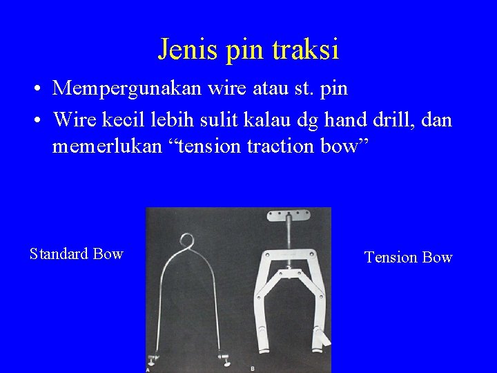 Jenis pin traksi • Mempergunakan wire atau st. pin • Wire kecil lebih sulit