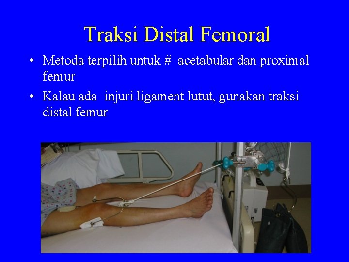 Traksi Distal Femoral • Metoda terpilih untuk # acetabular dan proximal femur • Kalau
