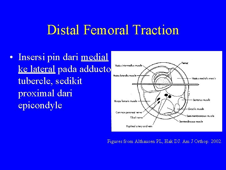 Distal Femoral Traction • Insersi pin dari medial ke lateral pada adductor tubercle, sedikit