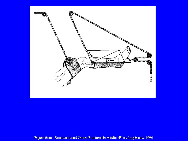 Figure from: Rockwood and Green: Fractures in Adults, 4 th ed, Lippincott, 1996. 