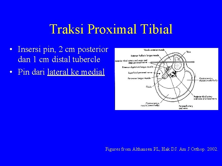 Traksi Proximal Tibial • Insersi pin, 2 cm posterior dan 1 cm distal tubercle